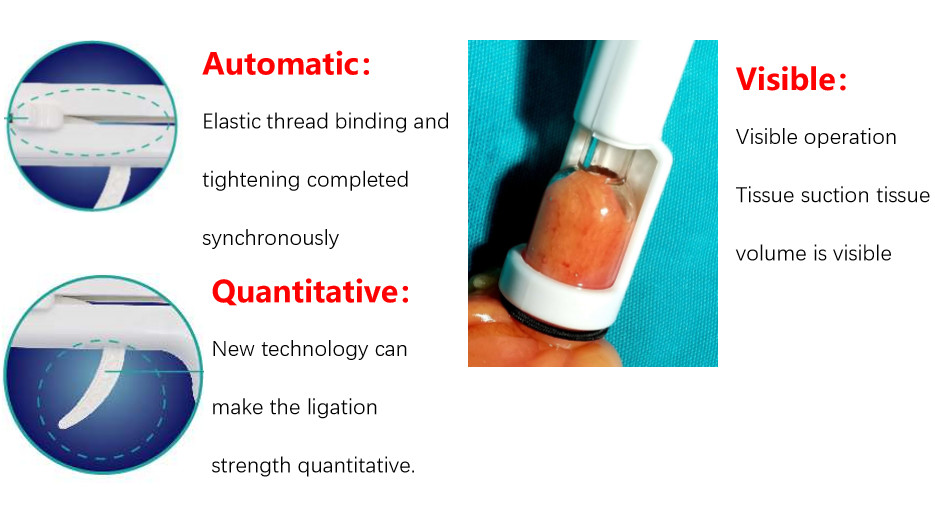 Automatic Hemorrhoid Removal Without Surgery , Internal Piles Treatment Curved Intraluminal Stapler