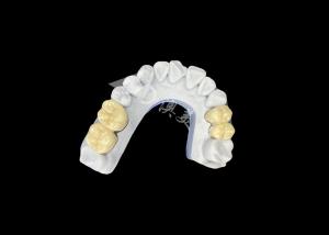 China Zirconia PFZ Porcelain Dental Crown From Professional China Dental Lab wholesale