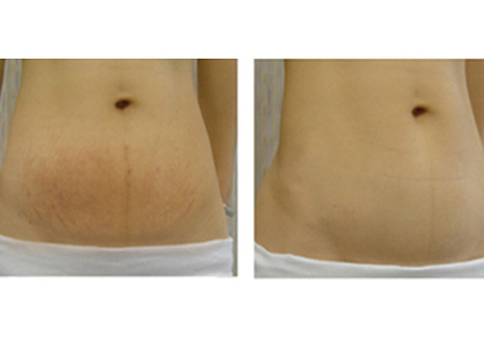 CE Stretch Marks Removal Machine Laser Erbium Glass 1550 NM