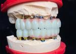 Polished Titanium Base dental Implant Ceramic Crown Bridge For Dental Restoratio