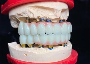 China Polished Titanium Base dental Implant Ceramic Crown Bridge For Dental Restoration wholesale