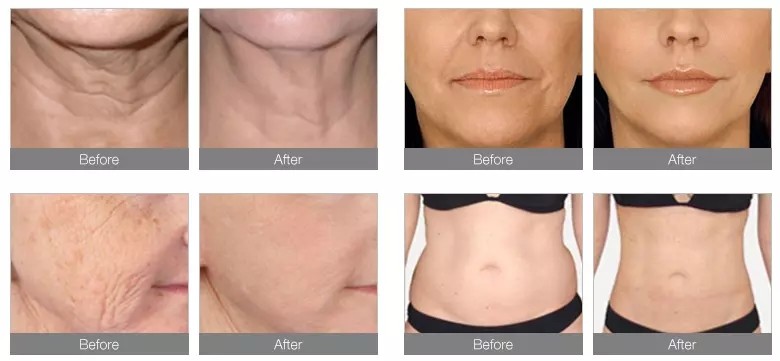 New Technology 2022 Skin Lifting Rejenvention Tightening New Doublos Gold Hifu Machine Korea With Vmax Rf Mfu Hifu Face