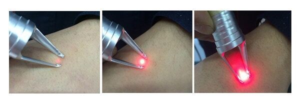 NUBWAY 980nm Vascualr Removal Machine/Skin Tag Removal,Vascular Removal/Spider Vein removal for whole body