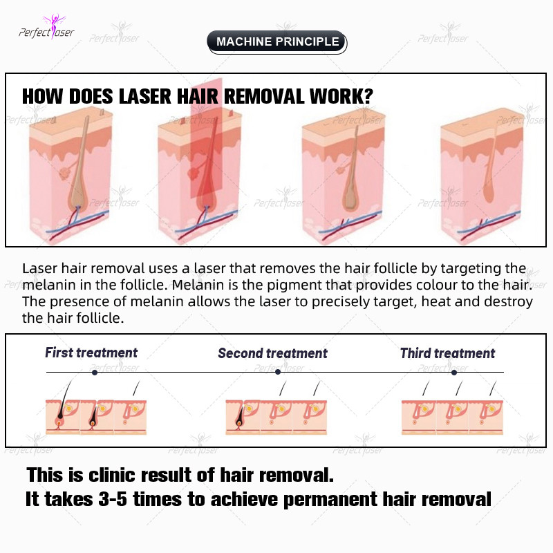 3500W 808nm Diode Laser Hair Removal Machine Skin Rejuvenation