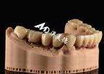 Functional Aesthetic Dental Implant Crown Bridge – Precision and Durability