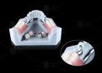 0.1mm Tolerance CEKA REVAX Attachment Titanium 3mm Vertical Clearance