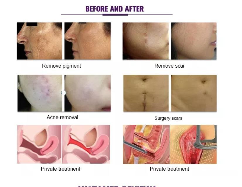 Professional C02 Vaginal Tightening Laser/Skin Resurfacing CO2 Fractional Laser Machine