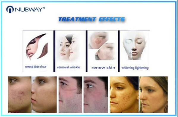 30w Fractional Co2 Laser Nubway Products Vaginal Applicator