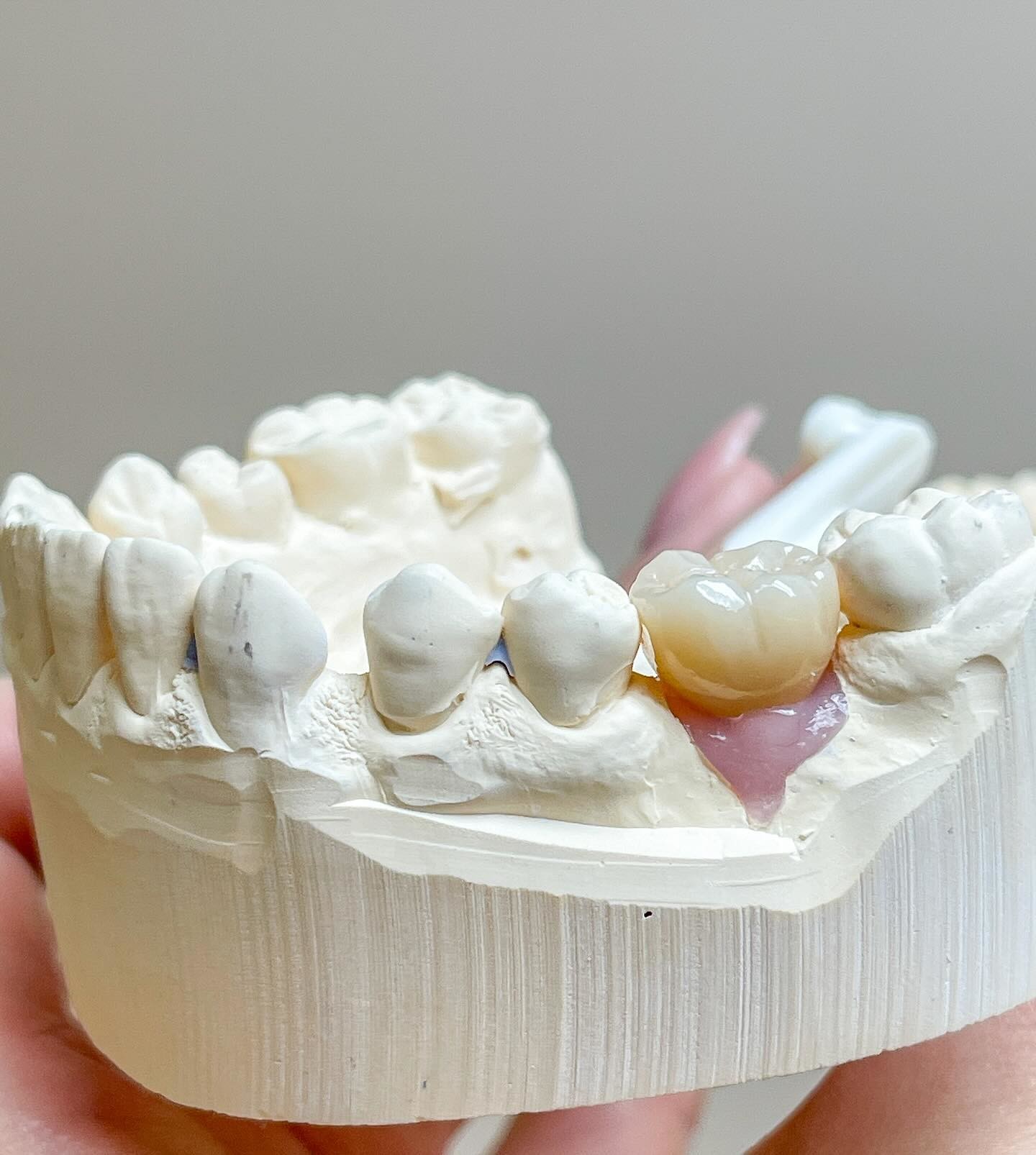 Screw Cement Retained Implant Polished Implants Supported Porcelain Bridge Full Arch