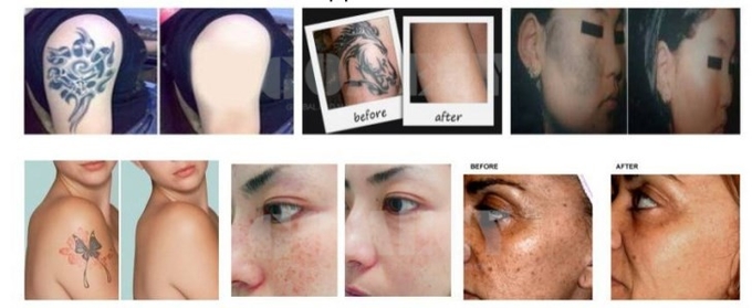 1000W Picosecond Laser Machine 110V / 220V Adjustable Spot Size 2-10mm For Tattoo Removal