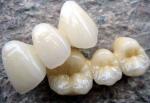 PFM Co Cr 3014652903 Ceramic Dental Bridge Custom Colour Stability