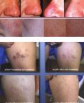 Latest Spider Vein Removal Machine
