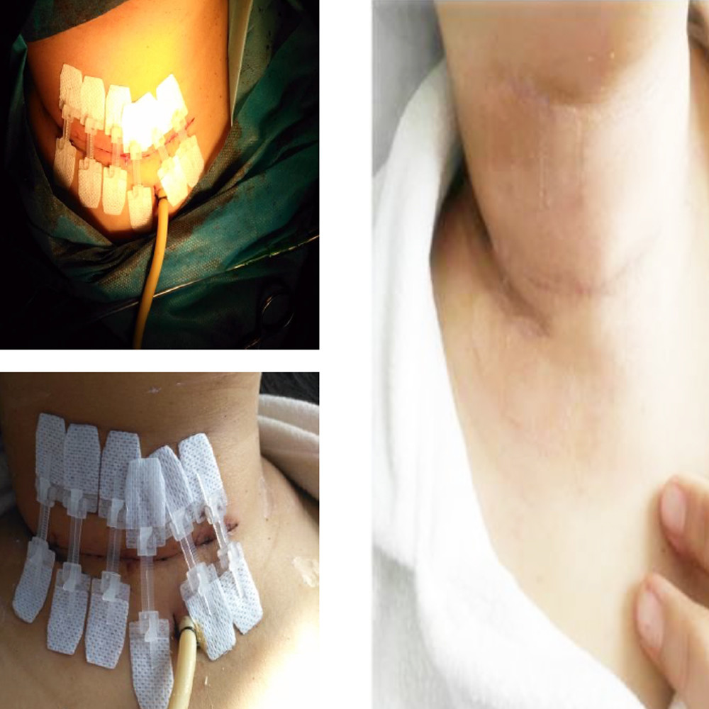 Surgeries Zip Wound Closure Device Plastic Material Multi - Sizes Without Stitches