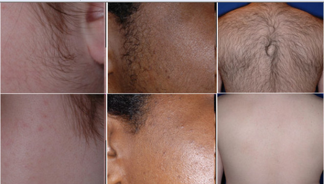 ipl flash lamp hair removal price ipl laser hair removal machine
