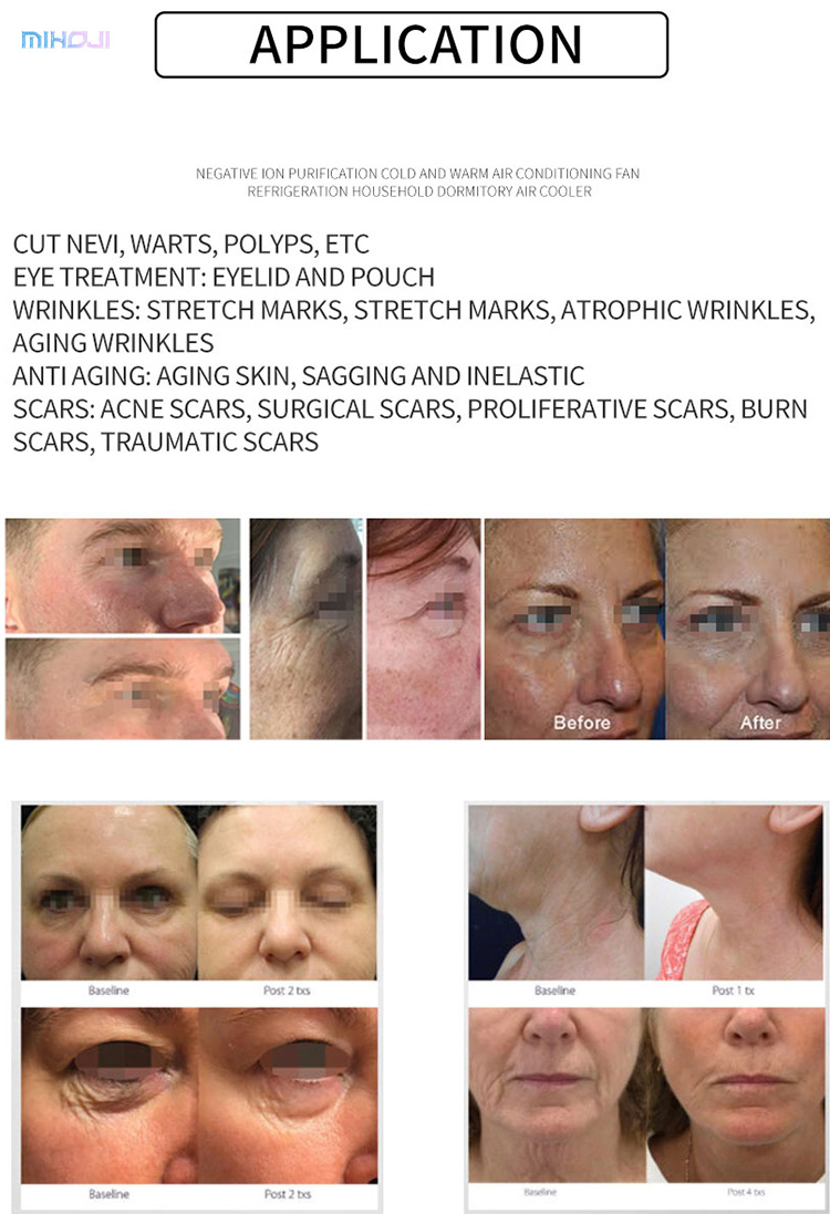 Advanced Plasma Spot Removal Pen for Fractional Anti-aging and Dark Spot Treatment