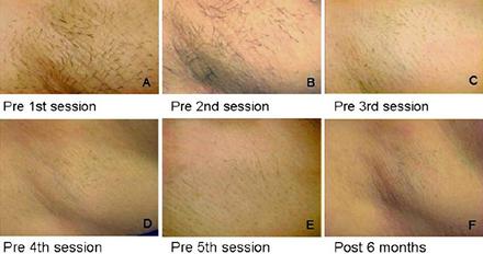 808nm Diode Laser Hair Removal Machine For Underarm , Armpit Hair Removal