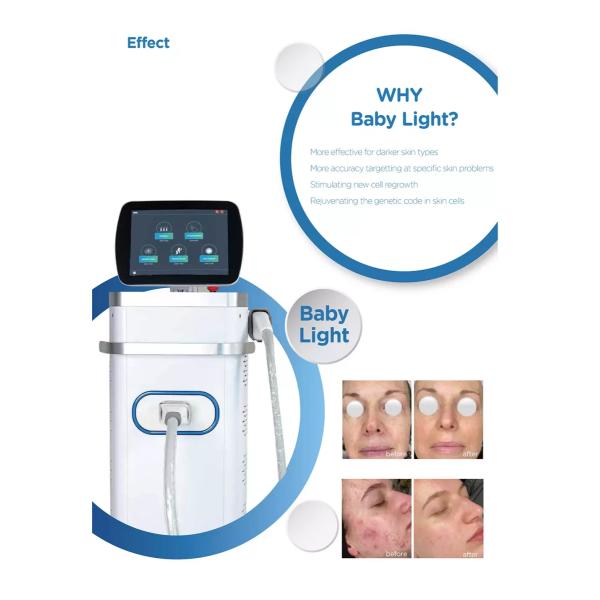 ADSS Most Effective Professional BBL Elight Painfree Opt Elight Beauty Machine