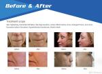 Best professional OEM / ODM fractional rf micro needle skin tightening wrinkle