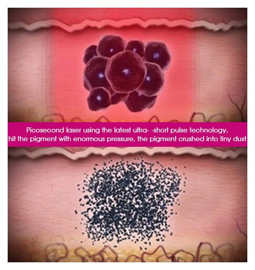 Picosecond Laser Tattoo Removal Equipment , Nd Yag Laser Equipment High Energy