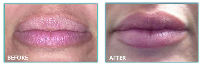 Juvederm Voluma Injectable Dermal Filler 2*1ml 24mg HA Dermal filler