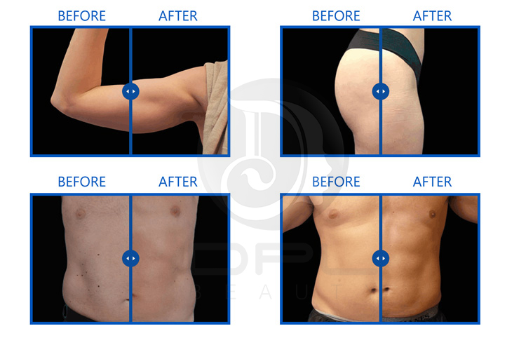 EMT18 Skin Tightening Neo Machine , EMS Fat Burning Machine 300W
