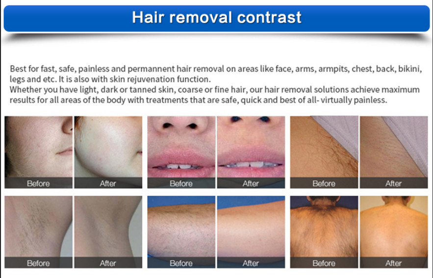 Painless Diode Laser Hair Removal Machine Q Switched Nd Yag Laser 1064 Nm