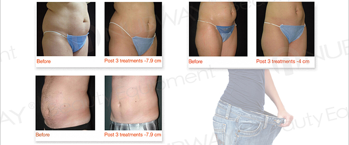 High intensity focused ultrasound hifu slimming machine hifu system