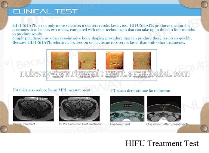 Portable HIFU slimming machine Treatment Test.jpg