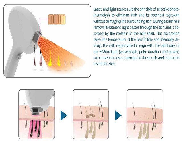 Germany Bar 10000000 Shot Hair Removal 808nm Diode Laser Machine
