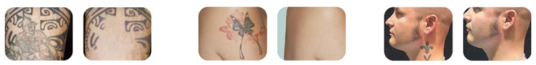 China manufacturer CE FDA approved 800w input power 1064nm 1320nm 532nm tattoo removal machine price in india