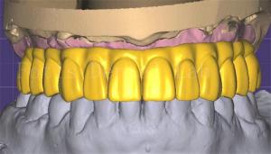 China Professional 3shape Crown Design Excellent Performance And Durability wholesale