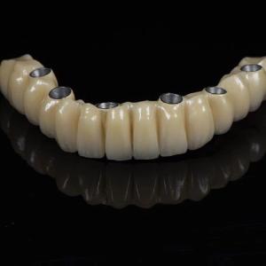 China All On 6 PFM Titanium Bridge Dental Crown Full Arch Implant wholesale