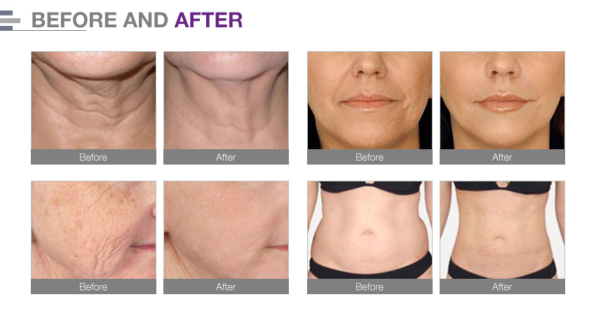 Hifu skin tightening fat removal machine FU4.5-7S - Buy Hifu skin ...