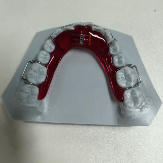Stainless Steel Acrylic Screw Expander Orthodontic Treatment Removable