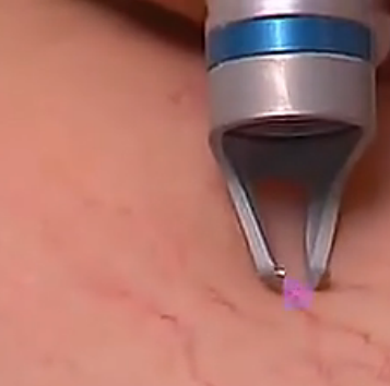 cheapest 980nm diode laser machines vascular removal spider vein diode laser 980nm