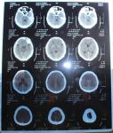 OEM Radiology PET X Ray Film 11x14 Inch Toner Laser Printing Medical Blue Film