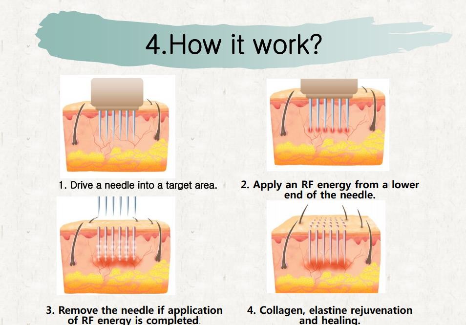 Fractional radiofrequency micro needling skin maintenance microneedle nurse system