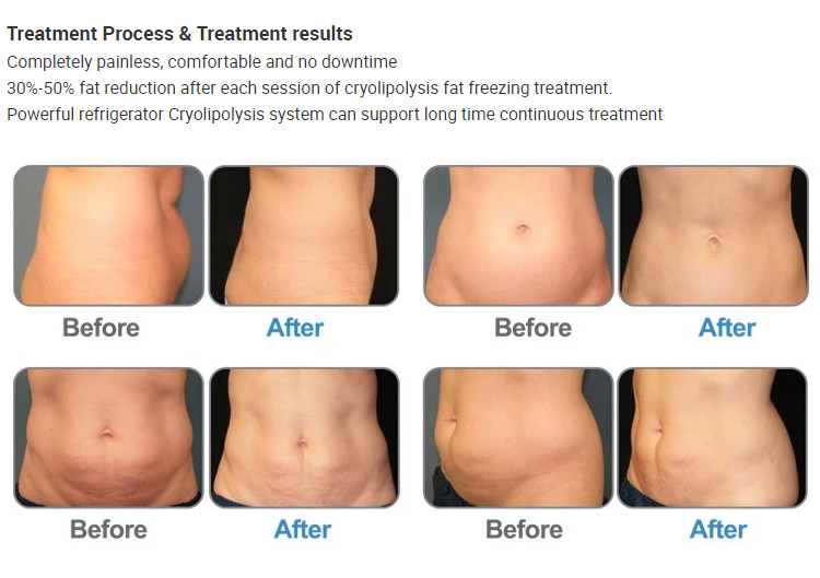 Vacuum Cryolipolysis Slimming Machine Body 360 Cool Fat Cavitation For Beauty Salon