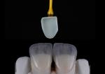 Custom Made Dental Restoration EMAX Veneers Beautifully Aligned Digital