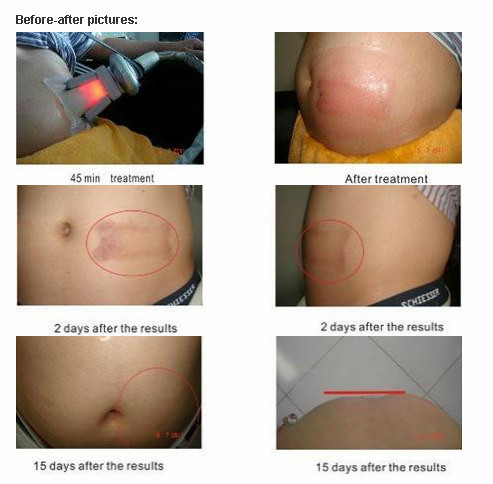 professional body slimming fat freezing apparatus.jpg