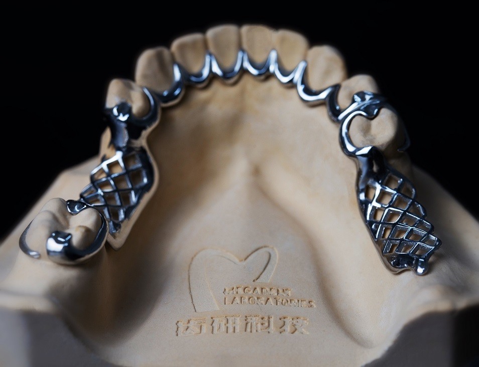 Casted Mandibular Arch Partial Denture Metal Framework