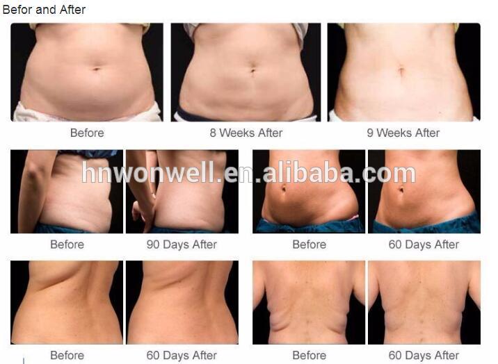 2017 Hottest fat freezing liposuction machine