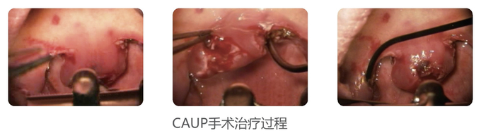 Cryogenic Radio Frequency Plasma Surgery System Minimal Invasive