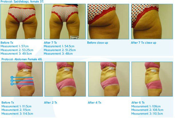 OEM & ODM Semiconductor + water + air system cool tech fat freezing slimming machine with 3 sizes of handles
