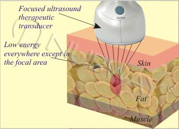 best price high intensity focused ultrasound technology slimming machine for sale