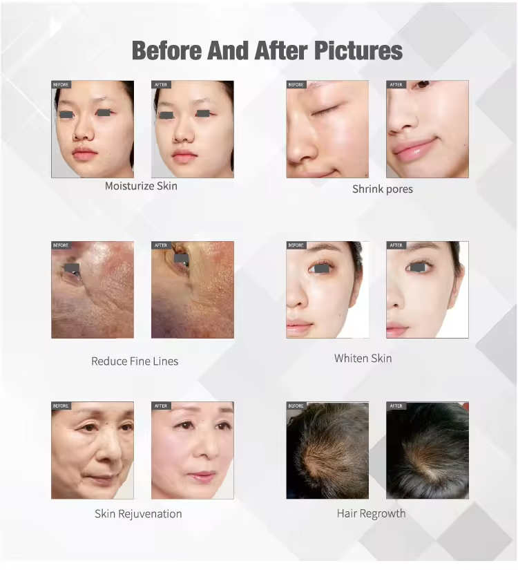 Portable RF Skin Tightening Machine 500W No Needle Mesotherapy Machine Anti Aging