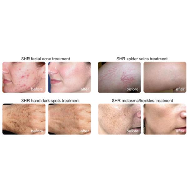 3 In 1 SHR IPL Hair Removal Machine Yag Laser Tattoo Removal Machine