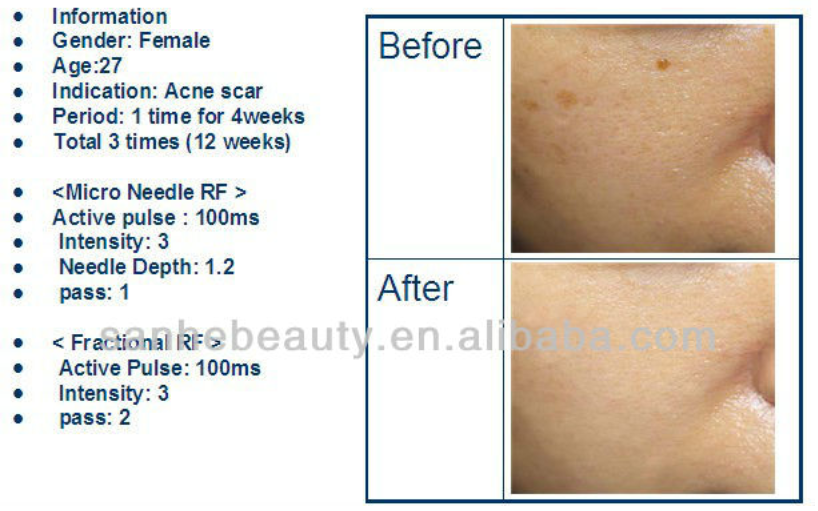 NEW Micro needle rf machine for skin tightening face left / fractional rf microneedle rf machine