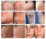Professional Soprano Titanium 808nm Diode Laser Beauty Machine