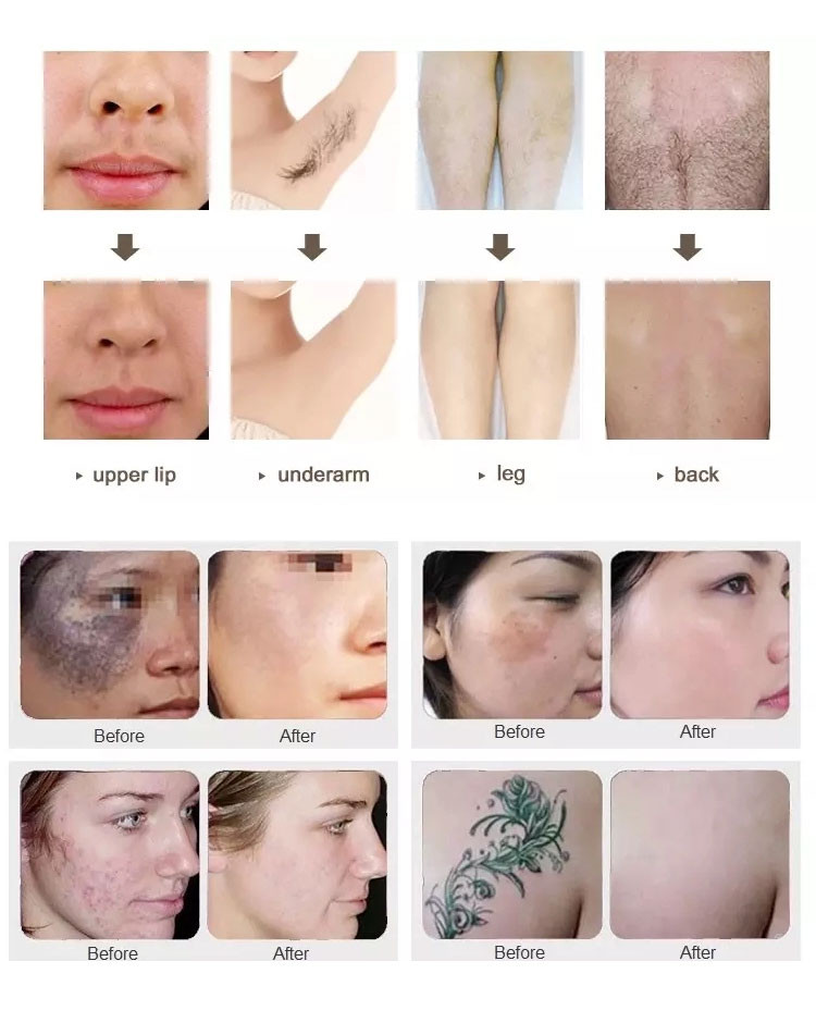 560-950NM IPL Laser Hair Removal Machine SHR Laser Beauty Equipment